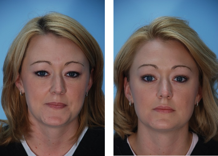 Операция по уменьшению малых. Ботокс в подбородок до и после. Ботокс в нижнюю часть лица. Ботокс до и после фото. Ботокс нижней трети лица фото до и после.